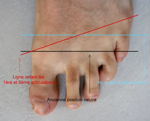 Schéma d'un pied avec la ligne reliant la 1re et la 5e articulation métatarsienne
